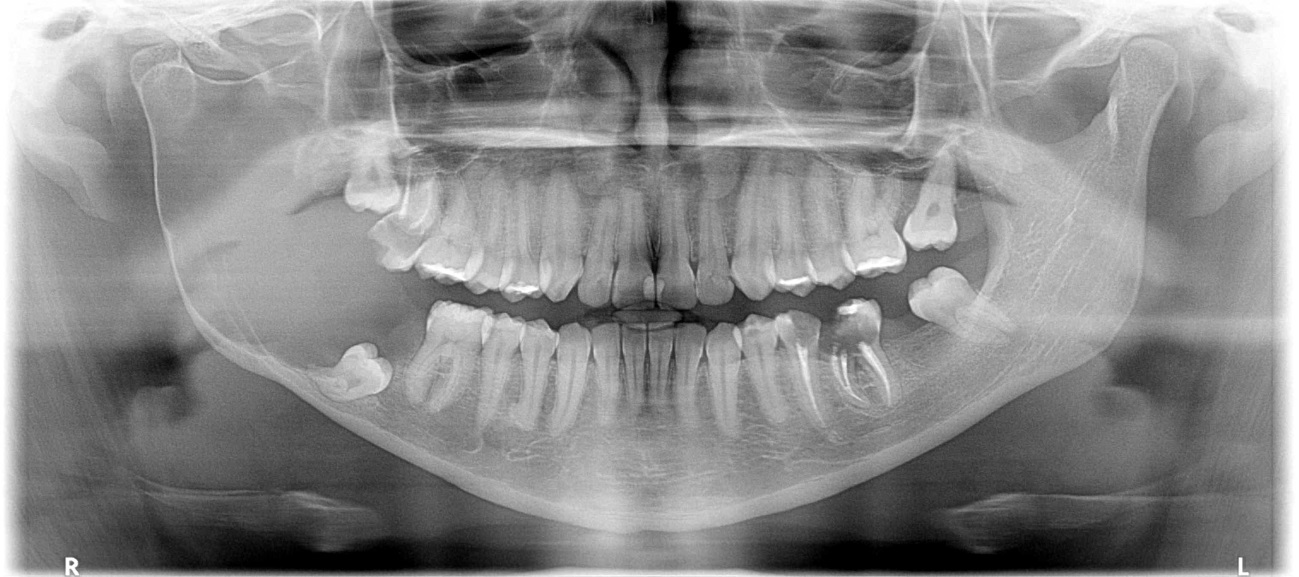 RELATO DO CASO Paciente do sexo feminino de 23 anos procurou cirurgião dentista, por apresentartumefação na região de posterior direita da face.