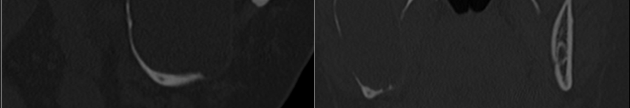 A Figura 2: Imagens de Tomografia Computadorizada Axiais (A: janela de tecido ósseo // B: janela de tecido mole) mostrando a lesão expansiva hipodensa na região do ramo ascendente da mandíbula do