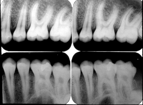 A: 5 -GCAGGATCCATATTAAATCTCCTTGT-3 B: 5 -GCGGTCGACAACCTGATAACAGTATT-3 As amostras de placa bacteriana subgengival contidas em recipiente com solução de Ringer reduzida foram homogeneizadas em