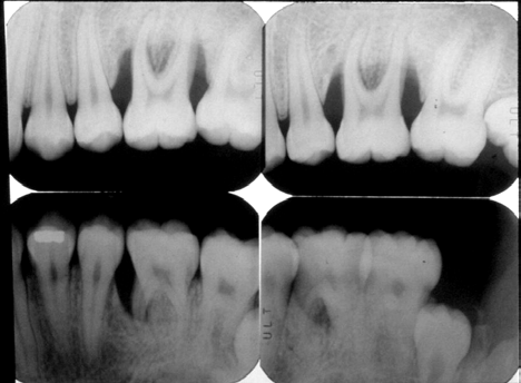 Figura 5 Aspecto radiográfico da região posterior superior e inferior do lado esquerdo do indivíduo V.R.