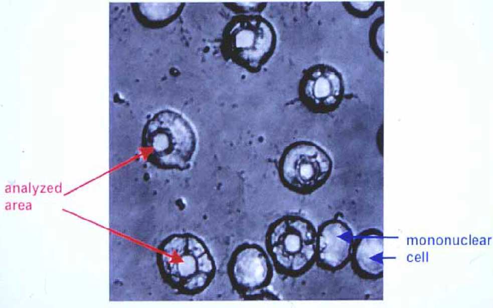 Prevalência e fatores de risco: EXPOSIÇÃO (toxicidade aguda: sais solúveis de berílio>100µg/m 3 ) 1971: 2 µg/m 3 média 8hs/ sem 2 a 19% dos expostos GENÉTICA: HLA-DPB1[Glu69] 80 a 97% + 40 a 50% dos