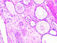 Neoplasias epiteliais do ovário Anatomia patológica A. Félix, C. Bartosch tubulares e quistos ou dispõem-se em áreas sólidas.