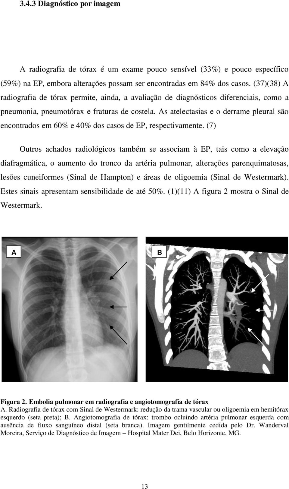 As atelectasias e o derrame pleural são encontrados em 60% e 40% dos casos de EP, respectivamente.