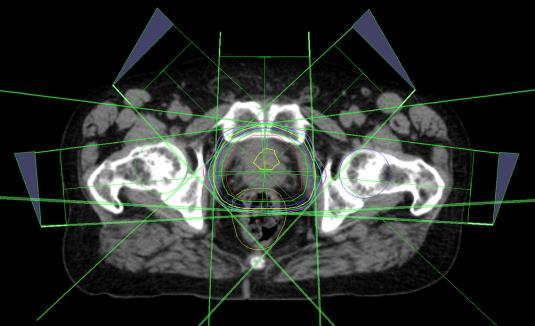 38 Uma boa maneira de analisar a diferença entre os planos com correção de heterogeneidade e sem correção de heterogeneidade, é comparando o histograma dose-volume.