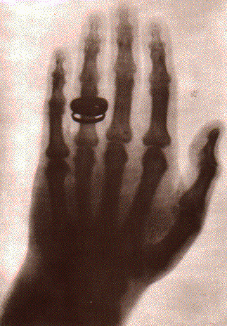 1. Introdução Descoberta da radiação ionizante: No dia 22 de Dezembro de 1895, o Sr. Roentgen tirou a 1ª radiografia com Raios-X (a mão da Sr.