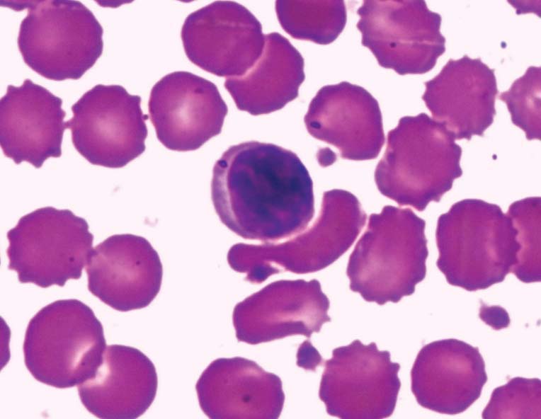 Sangue Aula 9 O linfócito representa de 18 a 42% do total dos leucócitos, possui uma forma esférica de tamanho variável, pouco citoplasma e um núcleo esférico que acompanha a forma da célula (Fig.