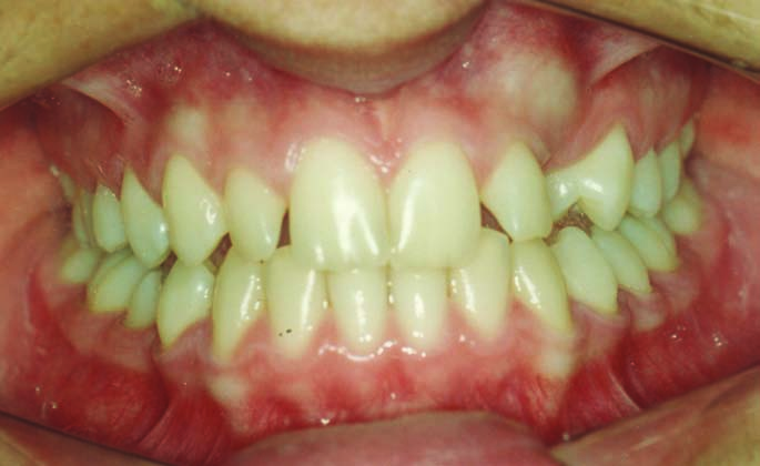 Relato de caso FIGURA 5: Vista intra-bucal lateral direita inicial.