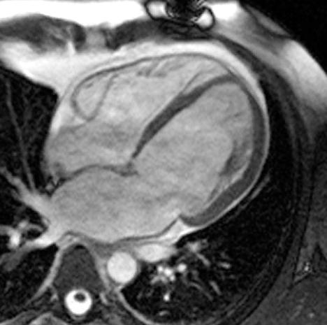 Tumores e massas cardíacas Os tumores cardíacos são geralmente diagnosticados após a realização da ecocardiografia transtorácica, sendo frequentemente um achado incidental.