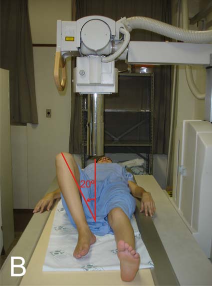 32 A incidência radiográfica Dunn 45 graus foi obtida, posicionando-se o paciente em decúbito dorsal, com flexão de 45 graus do quadril avaliado e com rotação neutra e abdução de 20 graus, estando o