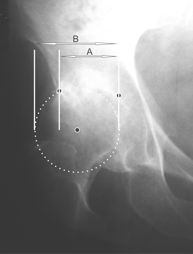 39 Figura 13 Medida do percentual de cobertura da cabeça do fêmur no quadril com osteoartrite (B = borda; T = ponto mais medial do teto do acetábulo). 4.