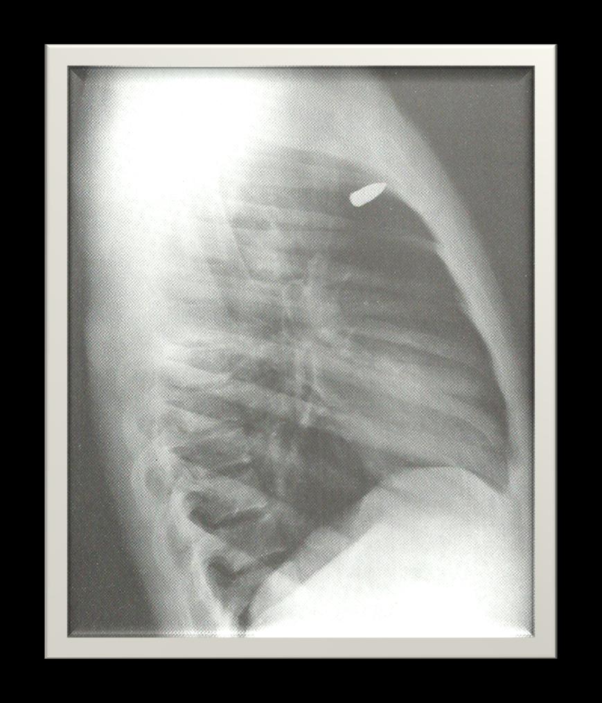 37 Tórax Perfil Radiografia feita em perfil, pode se diagnosticar que a bala estava localizada de modo