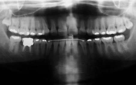 Utilização da distração osteogênica mediana sagital para tratamento da atresia mandibular Figura 15 - A) Radiografia panorâmica final e B) telerradiografia final.