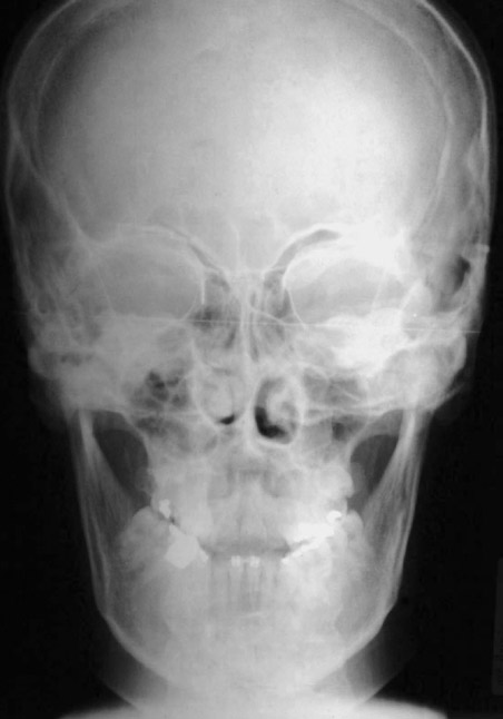 Utilização da distração osteogênica mediana sagital para tratamento da atresia mandibular FIGURA 4 - Telerradiografia inicial.