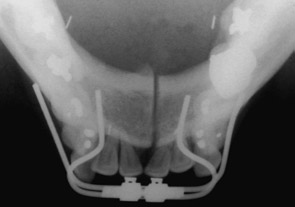 Figura 9 - Fase pré-cirúrgica. Aparelho distrator cimentado. A b c d Figura 10 - A) Osteotomia da sínfise. B) Ativação para completa fratura óssea.