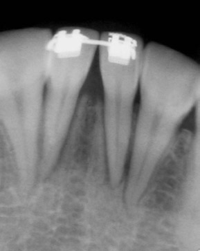 A B C D Figura 11 - A, B) Fase de estabilização (3 meses); C, D) radiografias periapicais (Visualização