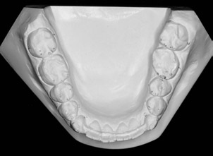 Maia, L. G. M.; Gandini Júnior, L. G.; Gandini, M. R. E. A. S.; Gonçalves, J. R.; Oliveira, C. A. Figura 14 - Modelos de estudo inferiores: inicial, intermediário (pós-distração) e final.