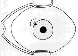 Glaucomas Tipicamente, esse tipo de glaucoma ocorre em olhos com o segmento anterior pequeno e cristalinos grandes.