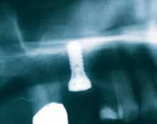 O uso clínico de CERASORB M na Cirurgia Oral Caso 1 Situação inicial: Maxila atrofiada subseqüente à perda dos dentes 25-27, densidade óssea D3 6 meses após a cirurgia com a implantação simultânea e