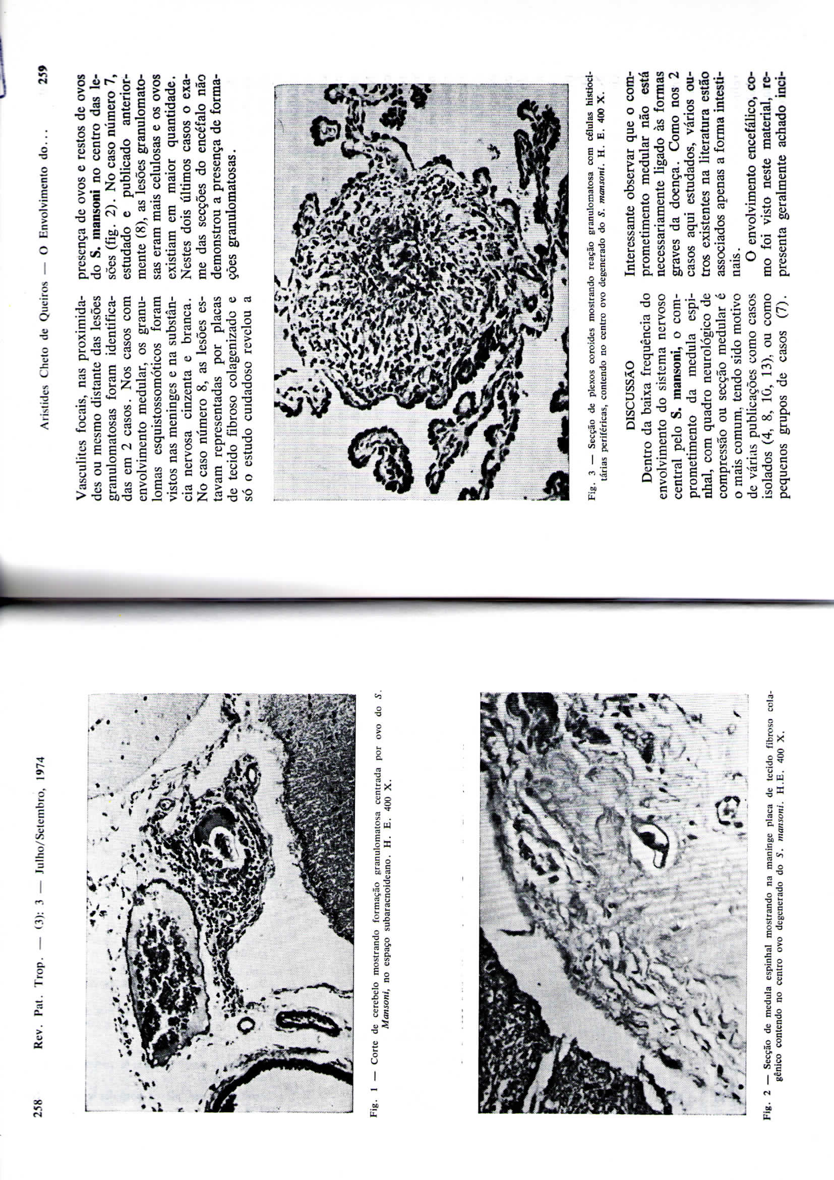 258 Rcv. Pat. Trop. (3): 3 Julho/Sctcmbro. 1974 Cheio de Queirós O Envolvimento do... 259 Vasculitcs focais, nas proximidades ou mesmo distante das lesões granulomatosas foram identificadas em 2 casos.