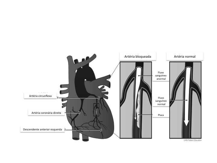 Como a doença arterial coronariana afeta seu corpo A doença da artéria coronariana pode resultar em angina e ataque cardíaco. Angina Seu coração precisa de sangue e oxigênio.