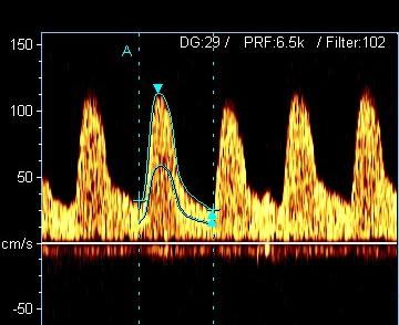 HIDROCEFALIA Hidrocefalia O Eco/Doppler Transcraniano revela-se num exame que permite a avaliação do Indice de