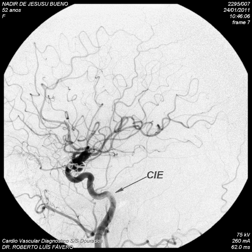 10 A Figura 2 mostra os aneurismas tipo IIb aneurisma temporal com circulação fetal, todos localizados na artéria carótida direita.