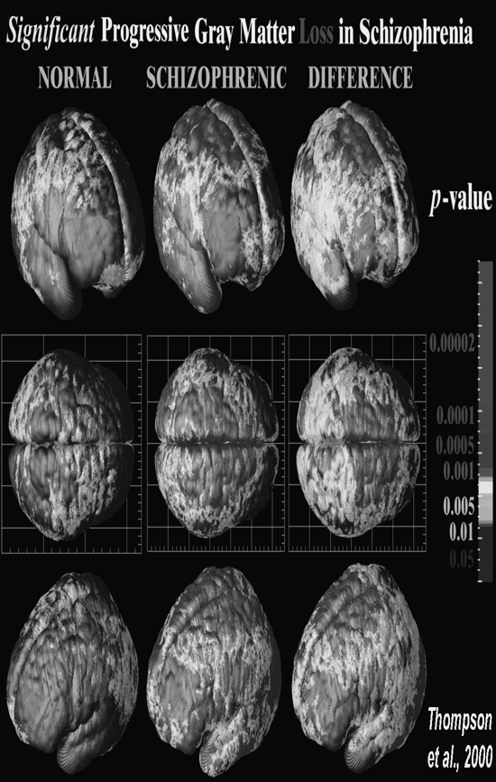 Aumento dos Ventrículos Diminuições volumétricas sutis Alterações mais frequentes Córte x temporal límbico Córte x prefrontal cíngulo anterior tálamo, núcleo caudado Neocórte x temporal Normal