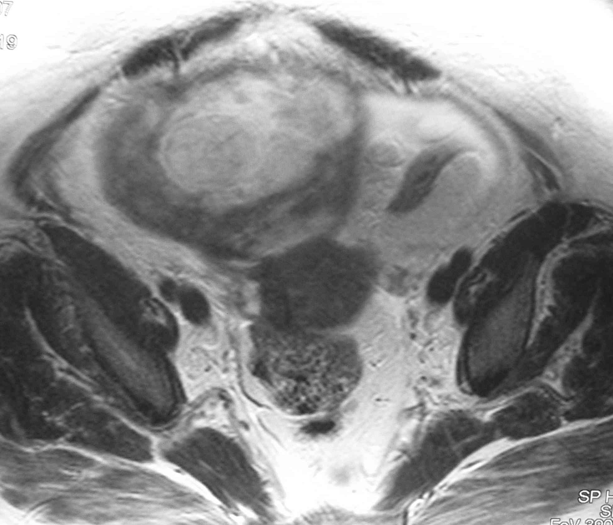 T1 com saturação de gordura Fig. 3 - RM - leiomioma com degenerescência hemorrágica em mulher de 44 anos. O sintoma é o aparecimento de dor gradual ou aguda.