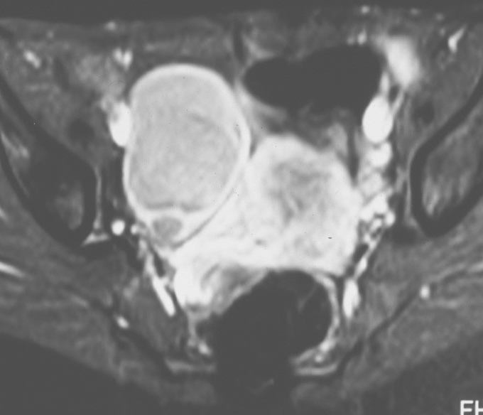 a b Fig. 6 - a) Na ecografia mimetiza um tumor sólido no ovário esquerdo, com multiplos folículos à periféria. b) Aspecto macroscópico de duas secções da peça de ressecção em cunha do ovário. Fig. 8 - a aparência ecográfica depende da fase de evolução do coágulo com o tempo, o mais típico são ecos reticulares ou um coágulo sólido intraquístico.