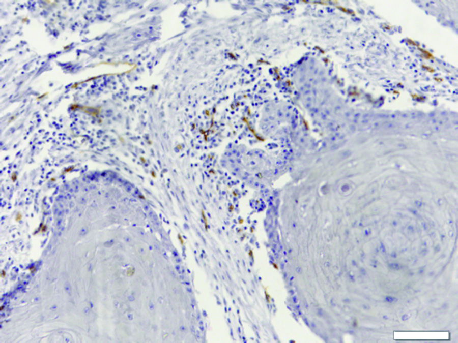 388 Alaeddini M, Etemad-Moghadam S Figura 2 Densidade microvascular demonstrando neoformação de vasos imunocorados com anticorpo monoclonal anti- CD105 (Ampliação original 3200).