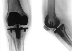 artroplastia com implante Osteonics, em que o LCP foi preservado Figura 2 Visão peroperatória do corte da caixa do componente femoral de