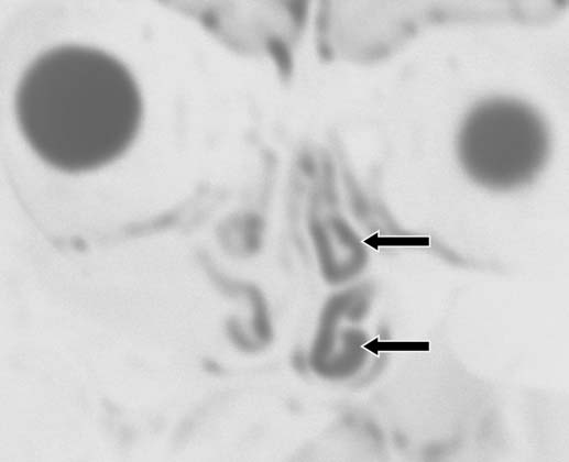 Complexo nasossinusal: anatomia radiológica A B Figura 3. A: Corte coronal de tomografia computadorizada evidenciando conchas nasais média e inferior mais volumosas à esquerda (setas).