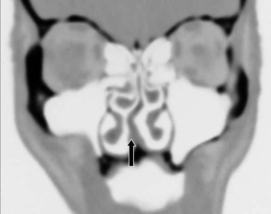 Complexo nasossinusal: anatomia radiológica óstios dos seios maxilares. Elas podem ter aspecto e tamanho variáveis e causar estreitamento do infundíbulo quando estão aumentadas.