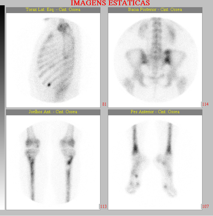 Fig.2 Legenda: cintilografia óssea com MDP- 99m Tc constatou áreas hipercaptantes nas regiões paranasal e maxilar bilaterais, extremidade proximal do úmero esquerdo, gradil