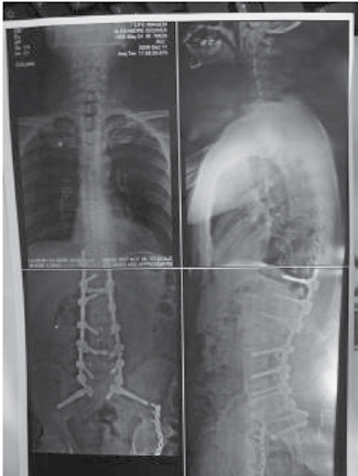 140 pre y postoperatorias, con la medida del ángulo de la cifosis torácica, lordosis lumbar y eje sagital.