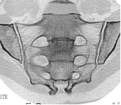 Montandon C et al. Figura 2. Survey no plano sagital mostrando a programação dos cortes no plano coronal oblíquo na RM. Figura 2 Figura 3 Figura 3.