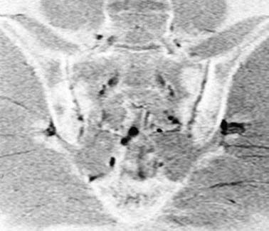Sacroiliíte: avaliação por imagem c) erosões ósseas corticais representadas por focos de alto sinal ou sinal intermediário em T1 e T2 na cortical sacral ou ilíaca, com irregularidade marginal e