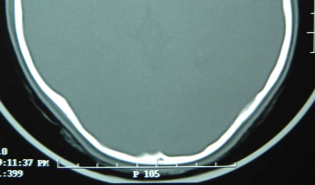44 (a) (b) FIGURA 1 Exemplos de fratura de crânio em crianças com TCE: (a) fratura linear diagnosticada por meio de radiografia simples de crânio, em perfil (seta); (b) fratura com afundamento