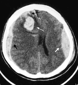 46 4.3.15 Hematoma subdural Lesão resultante do sangramento de veias corticais, as quais são particularmente frágeis próximas ao seio sagital superior.