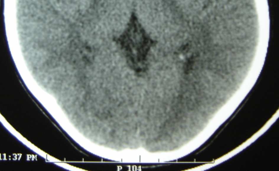 47 4.3.17 Pneumoencéfalo Refere-se à presença de ar em região intracraniana, habitualmente associado à fratura de crânio.