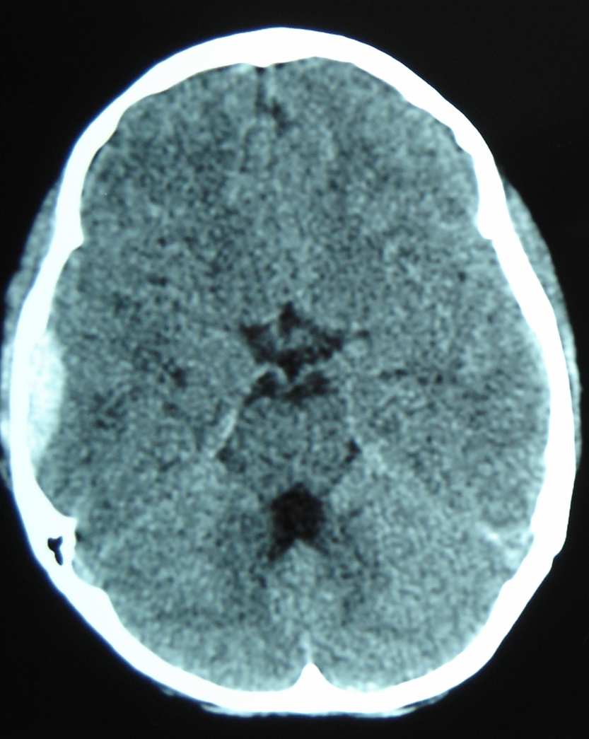 68 de imagem: cinco fizeram nova radiografia de crânio e seis realizaram nova tomografia. Não houve relato de internações ou óbitos.