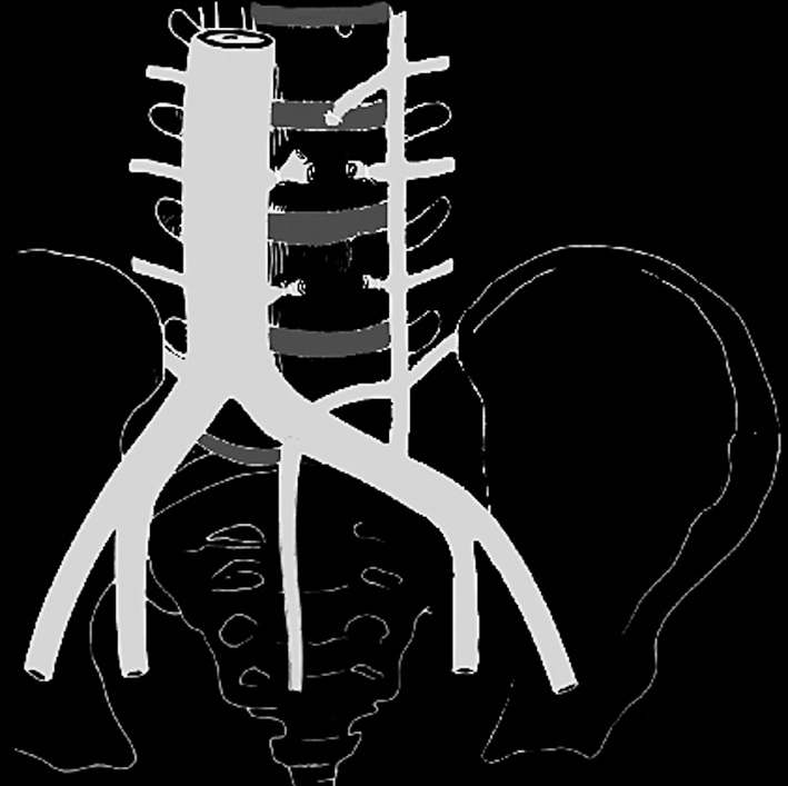 > Vias de acesso à coluna vertebral 1625 espaço pré-peritoneal seja bem visualizado, toda a cavidade abdominal e seu conteúdo são deslocados anterior e medialmente através de dissecção romba com