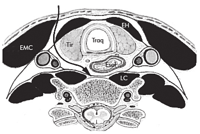 1616 Ortopedia e traumatologia: princípios e prática 77 Vias de acesso à coluna vertebral Sérgio Afonso Hennemann Rogério Kipper Picada Fernando Schmidt ABORDAGENS PARA A COLUNA CERVICAL Via anterior