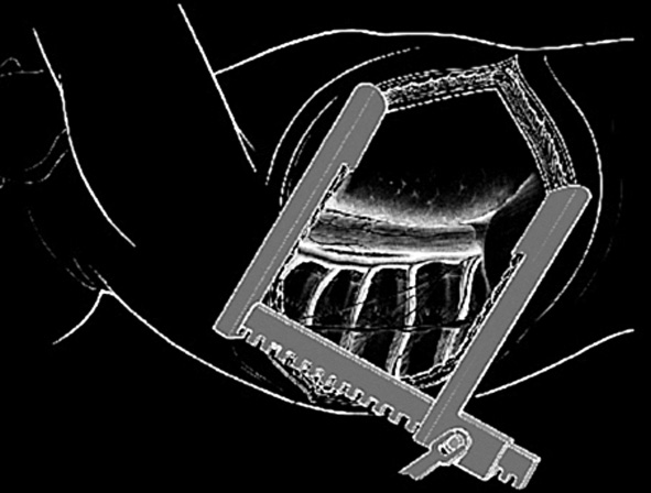 > Vias de acesso à coluna vertebral 1619 Após o procedimento cirúrgico principal ter sido realizado, o fechamento é feito aproximando-se a musculatura paravertebral, a fáscia, o subcutâneo e a pele.