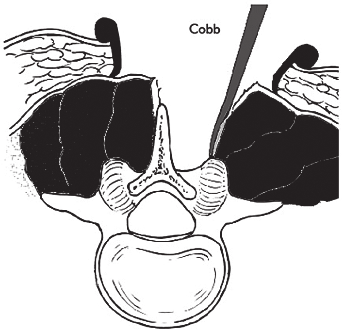 Usando-se o Cobb, descola-se a musculatura do ligamento interespinhoso com eletrocautério, coagulando- -se todos os vasos, pois o campo deve permanecer sempre exsangue (Figs. 77.20 e 77.21).