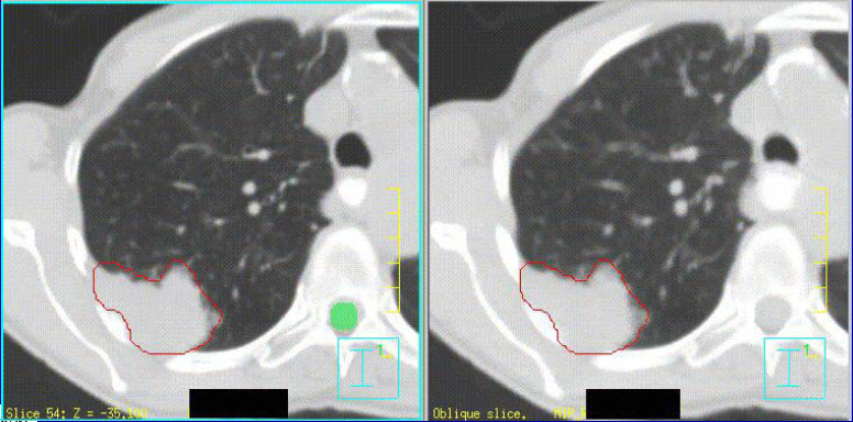 Perigos do MIP Tumor