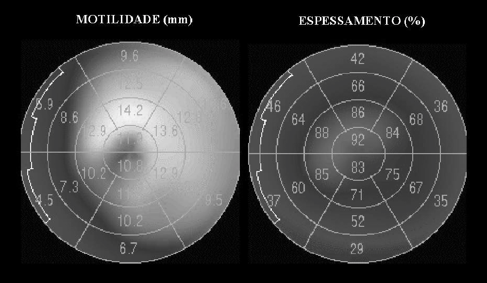 Arq Bras Cardiol I Diretriz sobre Cardiologia Nuclear Tabela VI - Análise segmentar da motilidade e espessamento sistólico do ventrículo esquerdo pela tomografia computadorizada por emissão de fóton