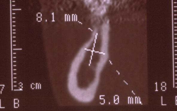 Disponibilidade óssea para instalação de implante na região edêntula de primeiro molar inferior A crista óssea foi desconsiderada até o momento em que ela atingisse uma espessura mínima de 5,0mm.