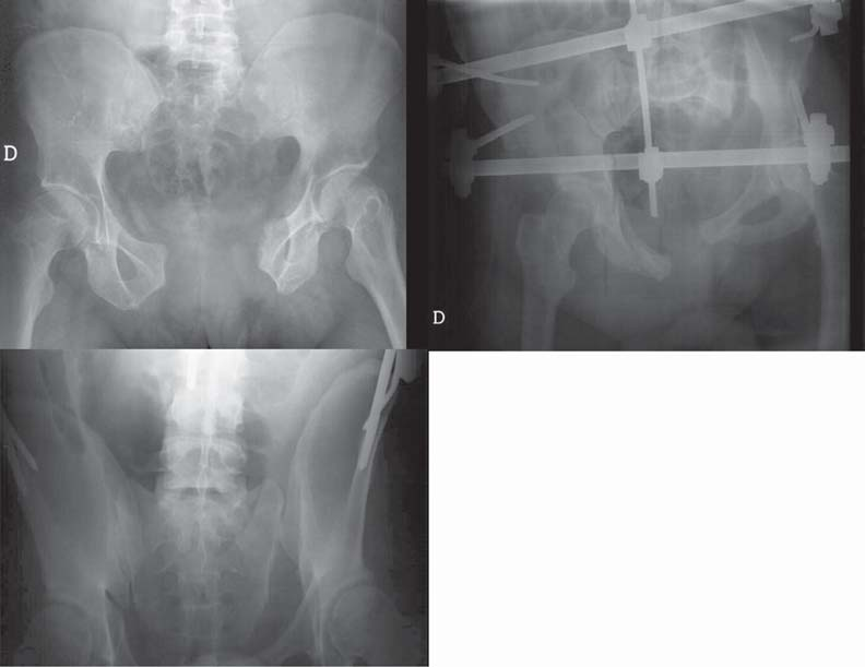 sacro-ilíaca ou do sacro (Figura 3.13). Lesão anterior e posterior podem ser homolaterais ou contralaterais (asa de cesto). Ambos os complexos ligamentares estão rotos.