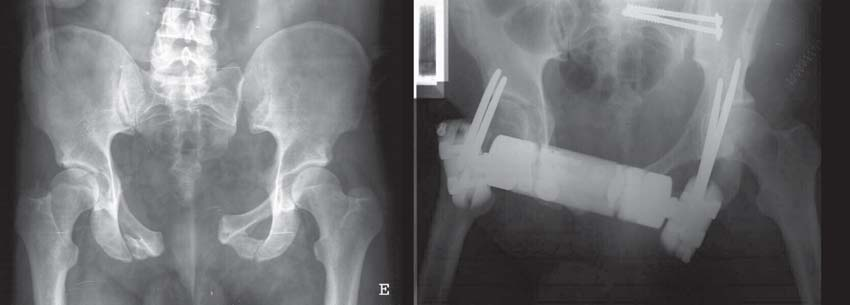 3 Bacia, Anca e Coxa A B Figura 3.17 A) Rotura pélvica dupla instável por compressão vertical (asa de cesto). Lesão anterior: fractura dos ramos pélvicos esquerdos.